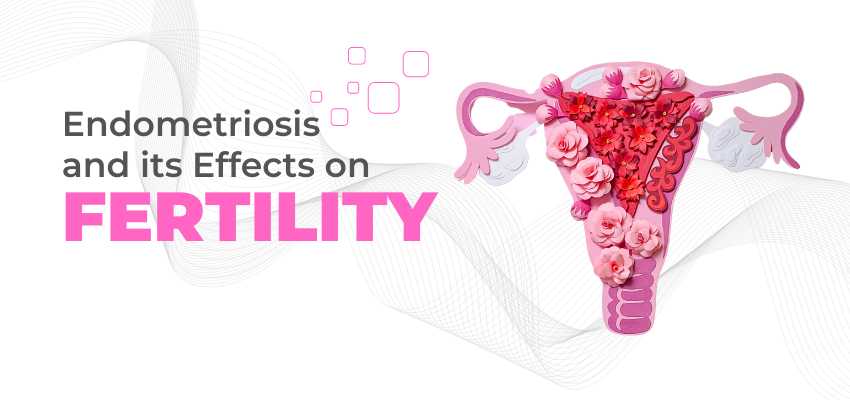 The Impact of Endometriosis on Fertility